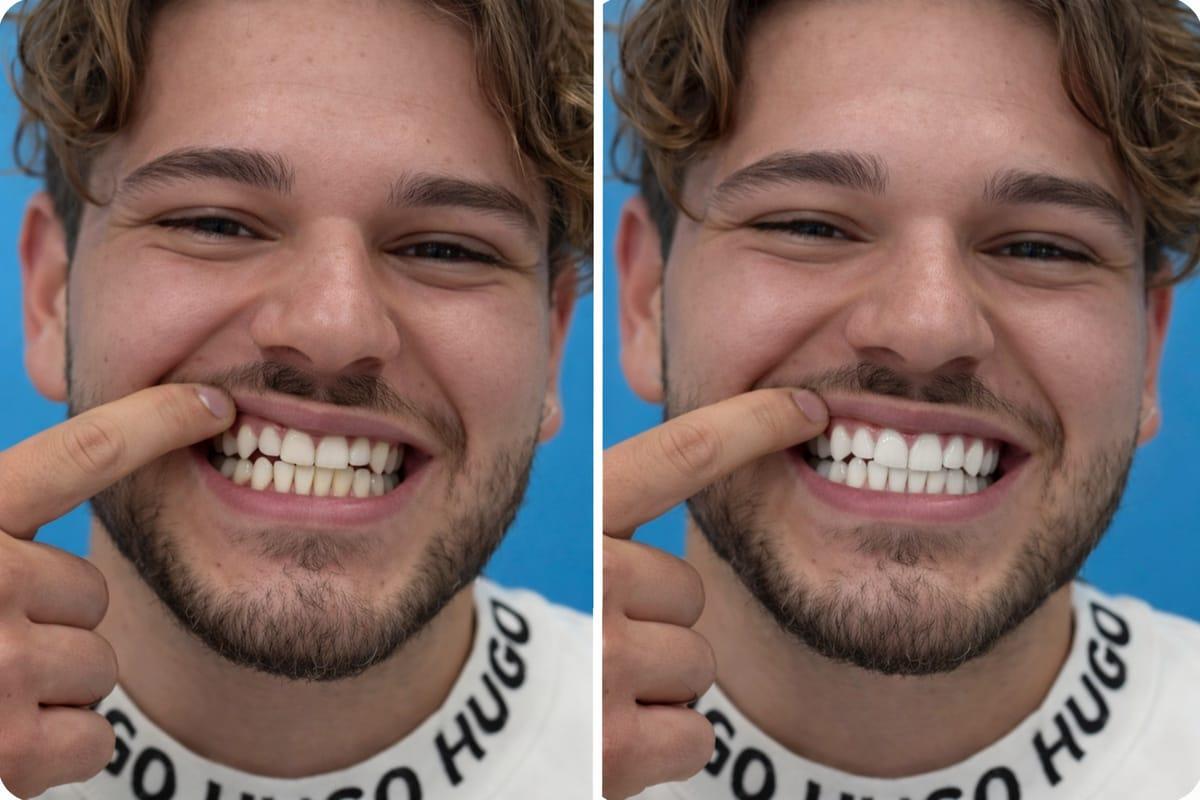 Vorher-Nachher-Vergleich eines Zahnbleachings bei Dental White, Kundin lächelt